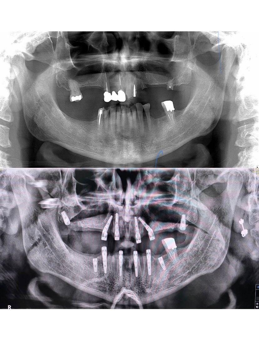 Case 7: panoramic radiograph before and after treatment, Primo Dental Clinic Tirana