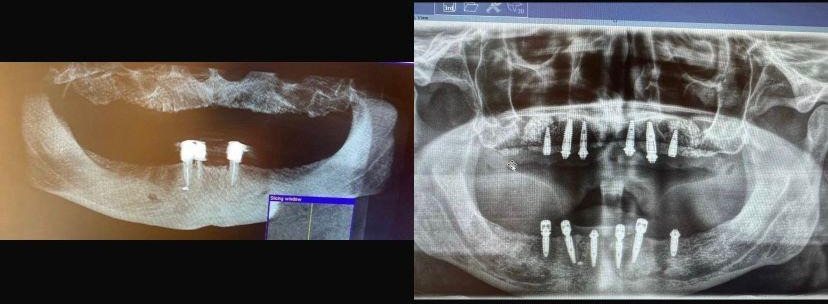 Case 9: panoramic radiograph before and after treatment, Primo Dental Clinic Tirana