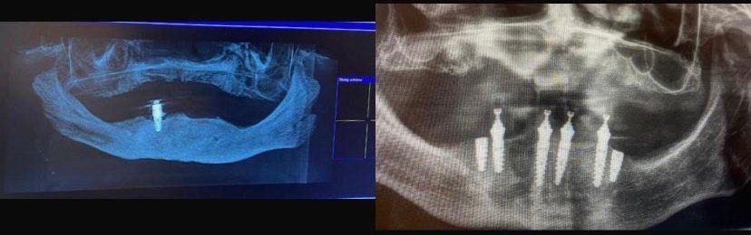 Case 13: panoramic radiograph before and after treatment, Primo Dental Clinic Tirana