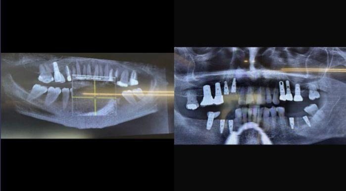 Case 17: panoramic radiograph before and after treatment, Primo Dental Clinic Tirana